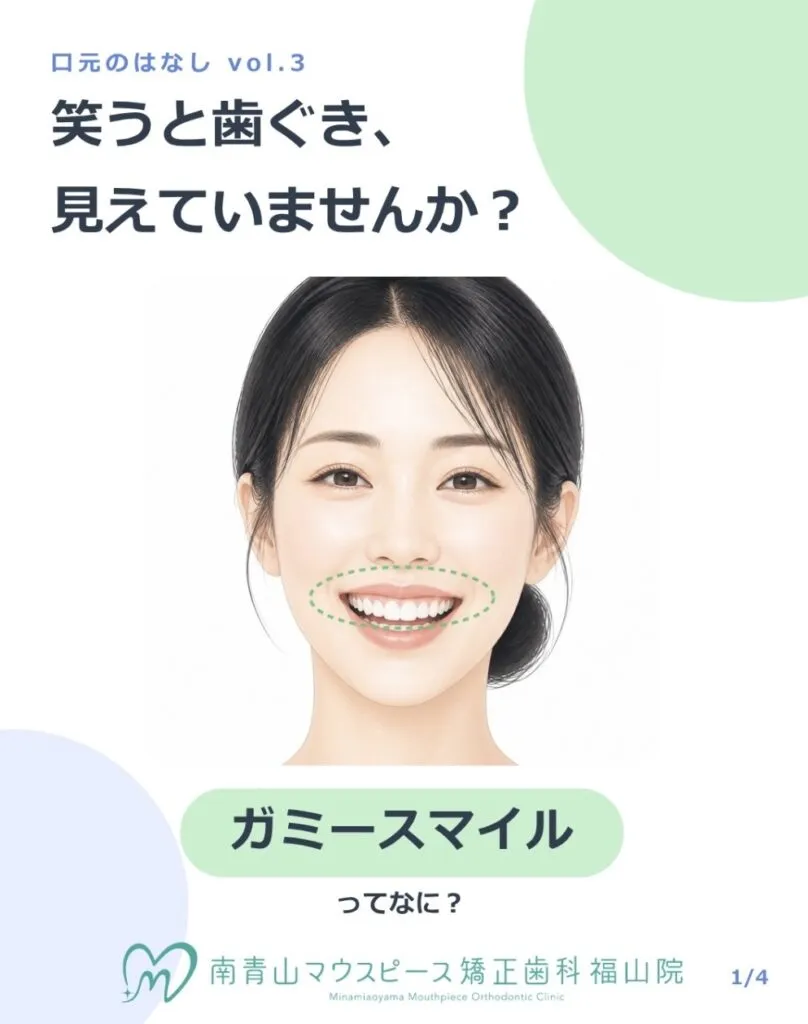 🦷ガミースマイルについて🦷